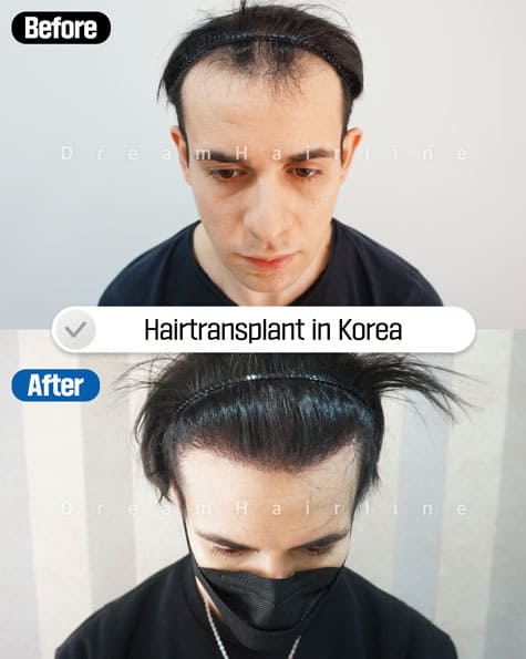 Before and After Male baldness1