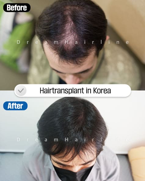 Before and After Male baldness2