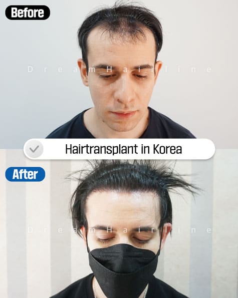 Before and After Male baldness3
