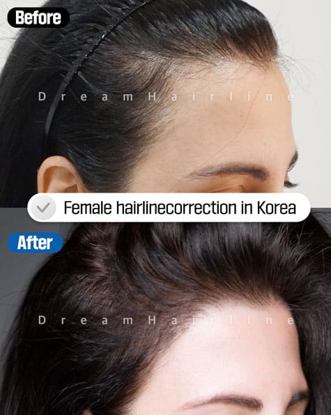 Before and After Fmale baldness1
