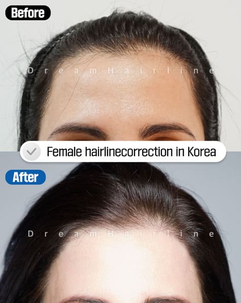 Before and After Fmale baldness2