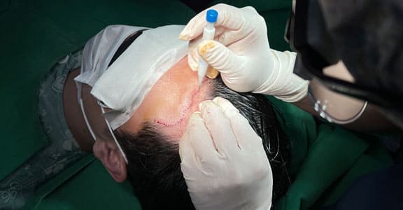 Transplant procedure 05
